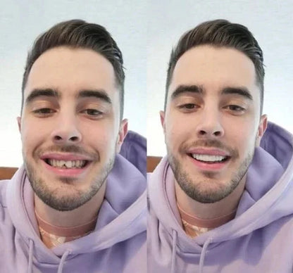 InstaSonrisa™ Carillas Dentales