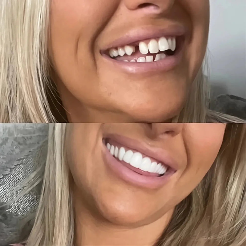 InstaSonrisa™ Carillas Dentales
